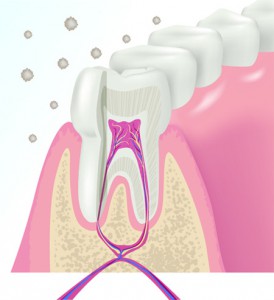 Surgical Root Canal Therapy