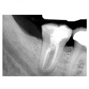 1 pre-op8