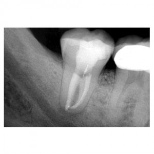 5 post op 32