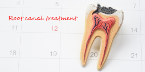 root canal treatment in calendar