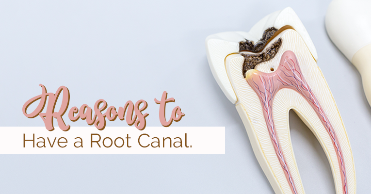 3 Reasons to Have a Root Canal
